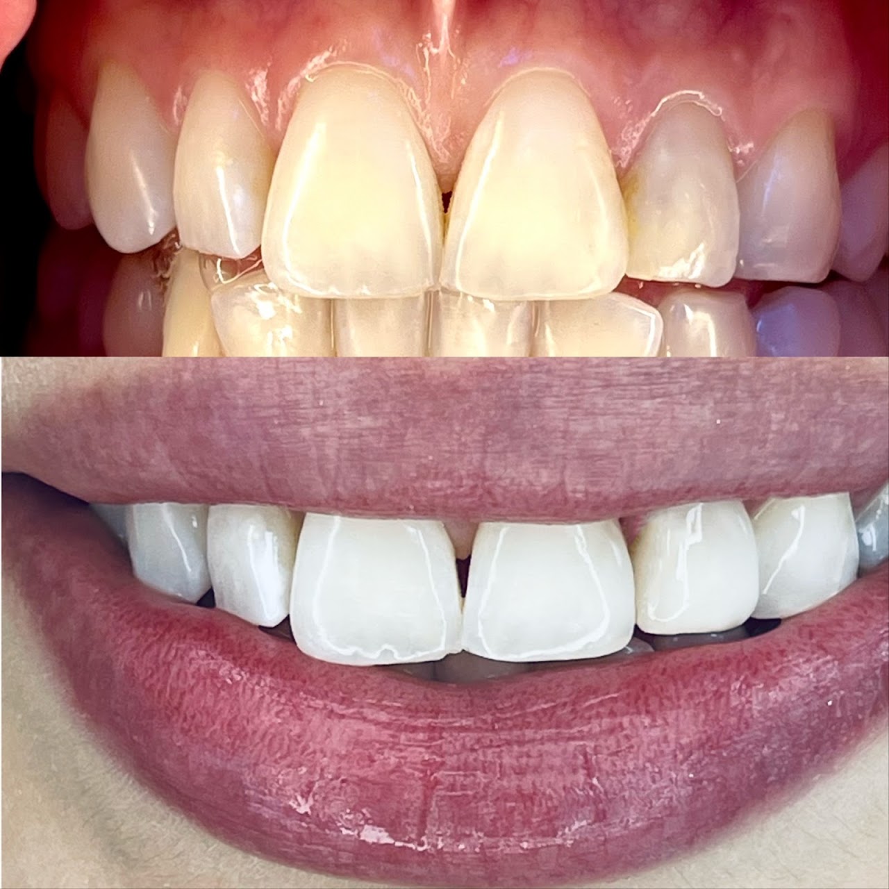 Blanqueamiento dental, antes y después
