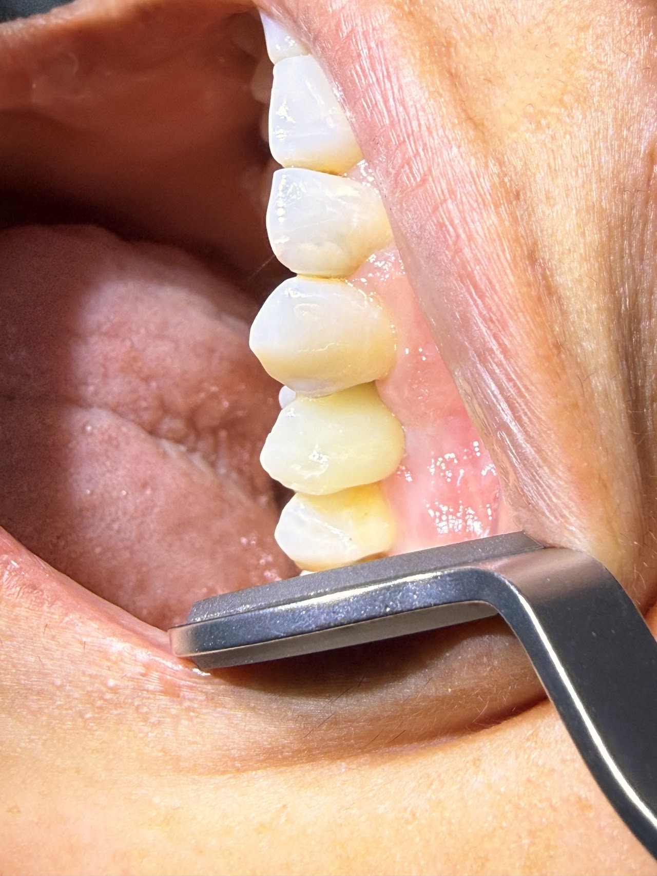 Tratamiento de estética dental